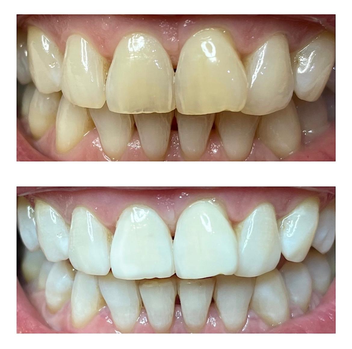 Aufhellungsergebnis mit natürlichem Weißton bei Frontzähnen