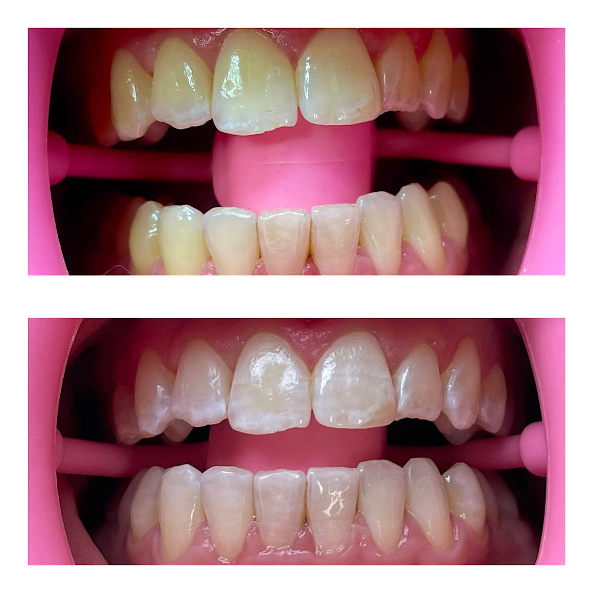 Gleichmäßiges Bleaching mit harmonischem Farbton