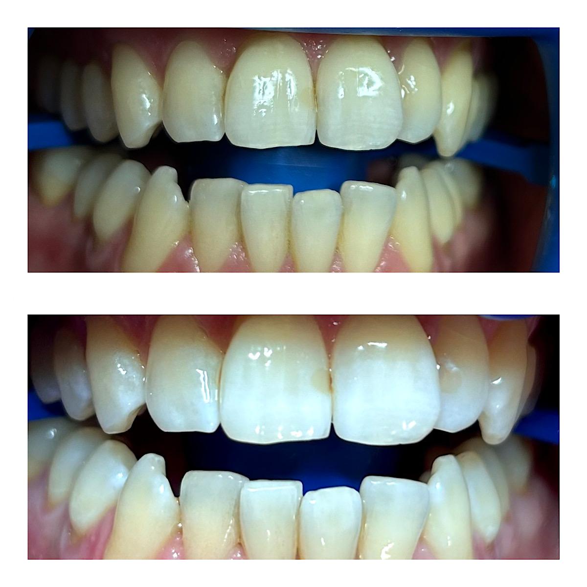 Intensivbleaching mit klarer Helligkeitssteigerung